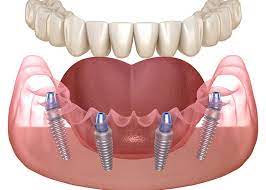 Choosing The Right Dentist For All On 4 Dental Implants